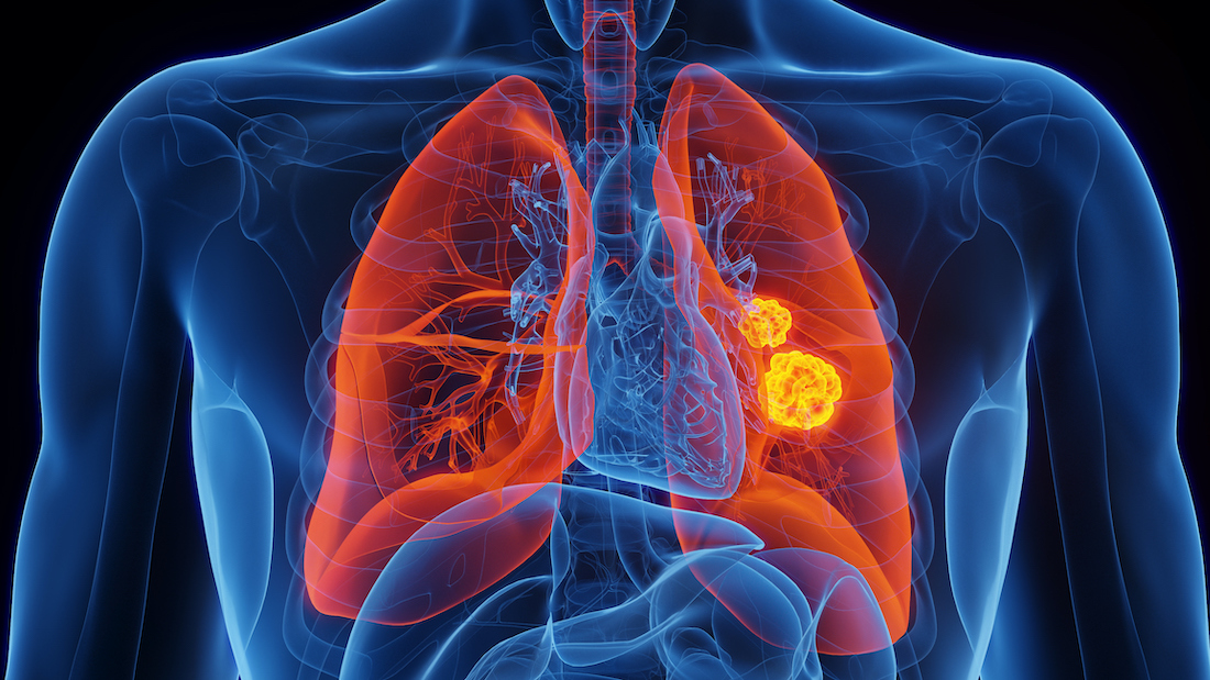 Trials begin for lung cancer vaccine that could eradicate deadly ...